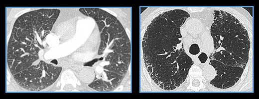 A computer screen showing a still image from CHEST's thoracic radiology imaging course