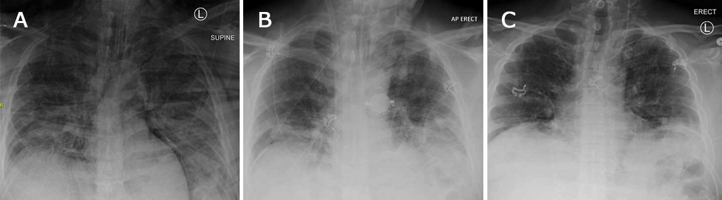 X-ray of the chest on the day of ECMO initiation