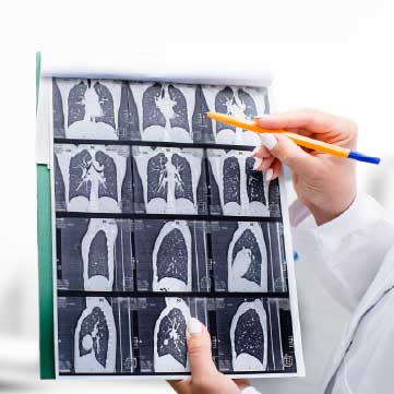 Lung cancer screening