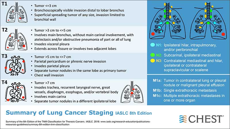 Summary of lung cancer staging infographic