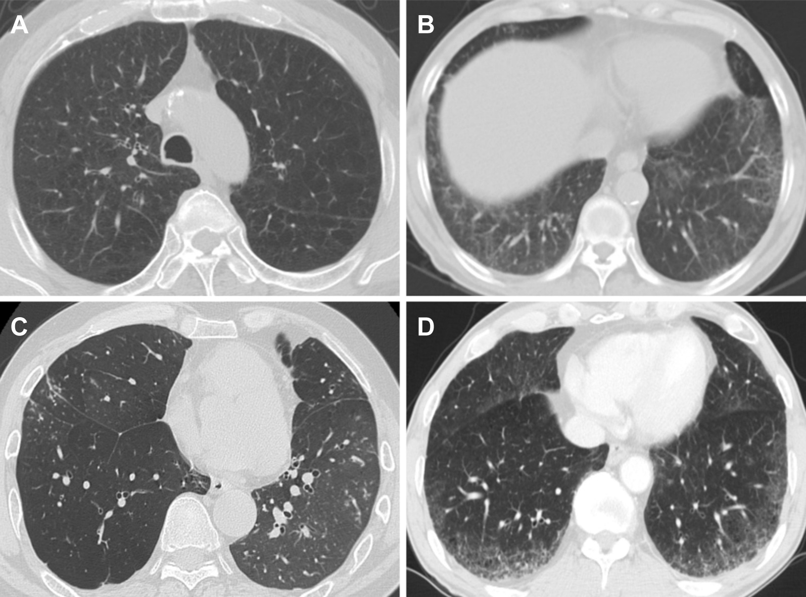 CT findings of COPD patients with or without ILA