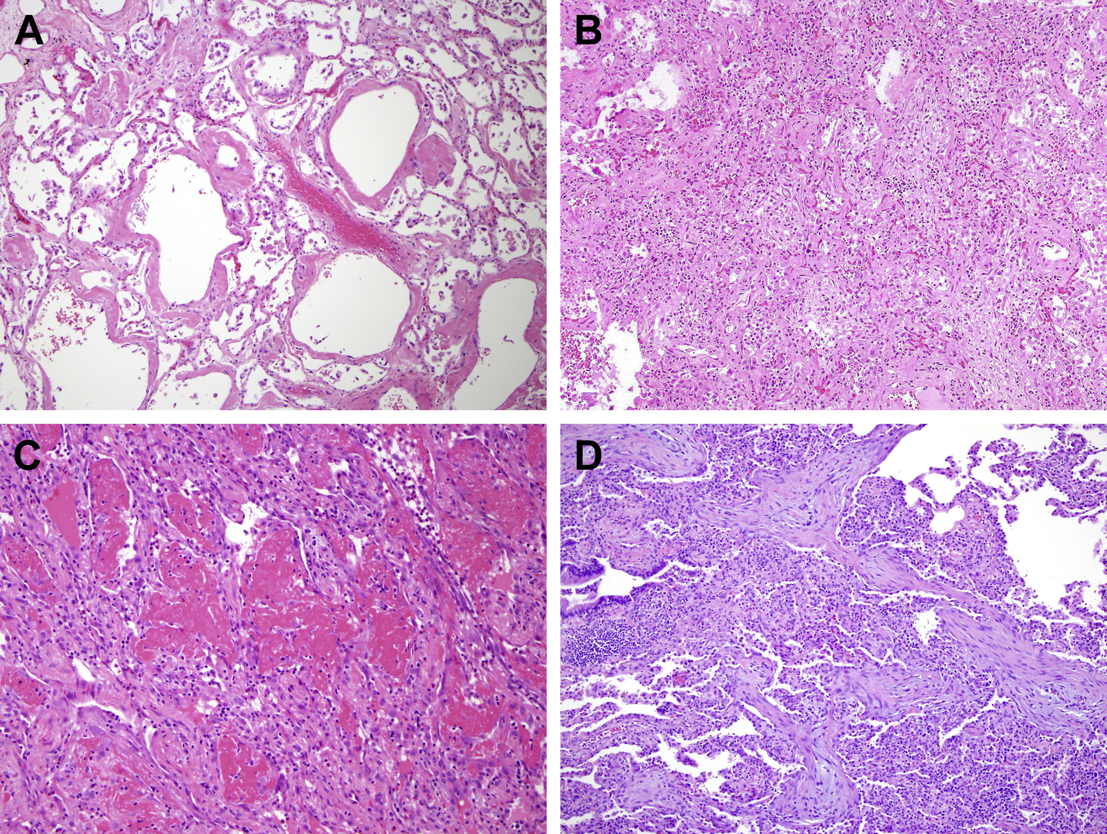 Histopathologic examples of acute lung injury pathology.
