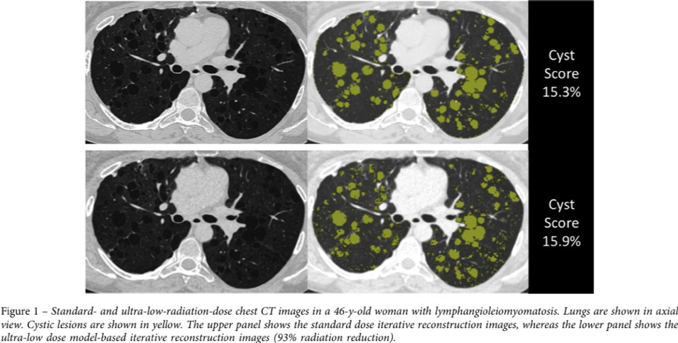 CHEST CT scan