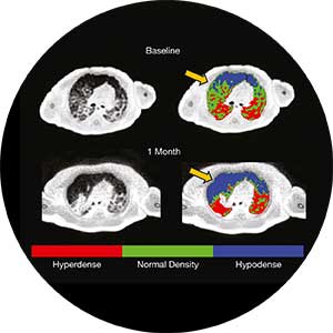 MRI scans showing one-month change in parenchymal lung density for a patient with bronchopulmonary dysplasia