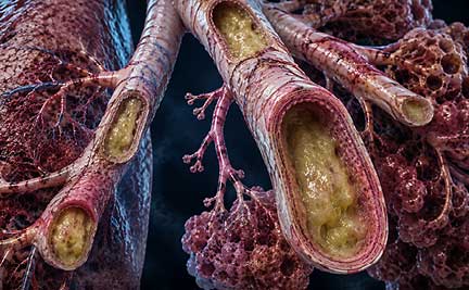 Depiction of bronchiectasis with dilated bronchi and excessive mucus in human respiratory system