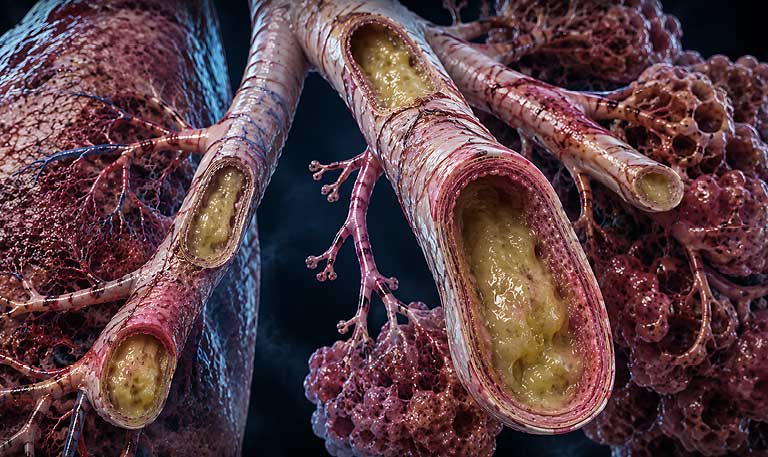 Bronchiectasis with dilated bronchi and excessive mucus in human respiratory system