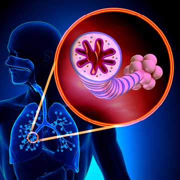 Asthma in the lungs