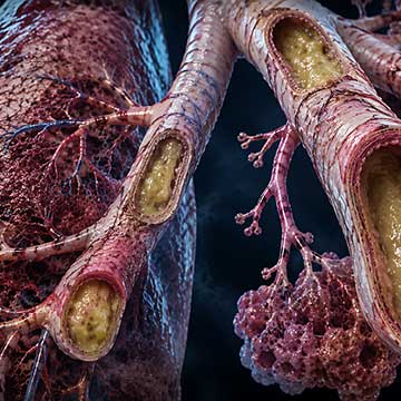 Depiction of bronchiectasis with dilated bronchi and excessive mucus in human respiratory system