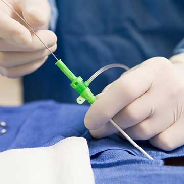 Hands holding a catheter